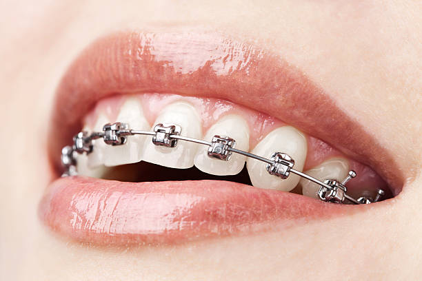 Clear aligners  Transparent Teeth Braces in Chennai